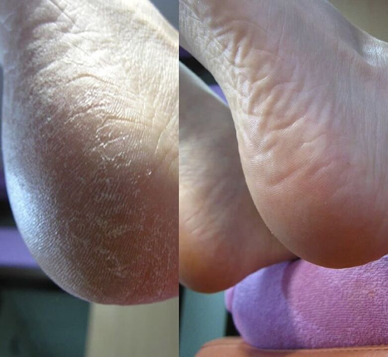 Foto van de hiel van de voet voor en na het gebruik van Zenidol-crème