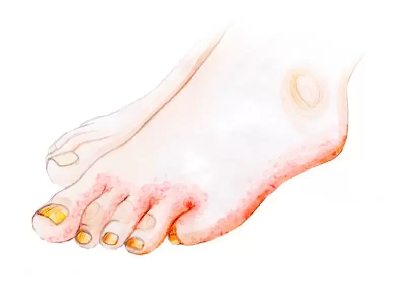 Schimmel op de tenen en hoe de Zenidol-crème moet worden aangebracht