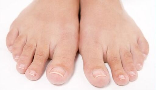 gezonde voeten na behandeling met schimmel