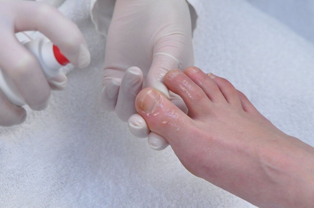 schimmel nagel behandeling