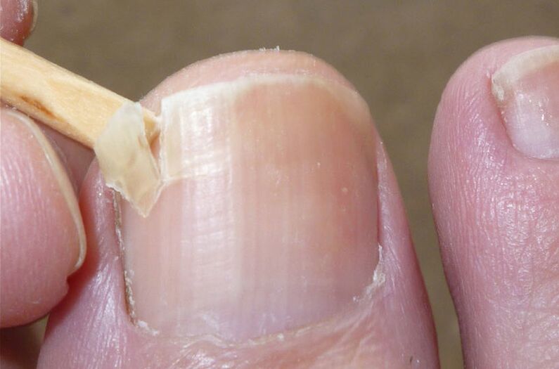 Beschadigde nagels zijn een risicofactor voor een schimmelinfectie