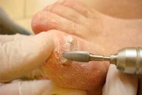 Mechanisch snijden van de nagelplaat