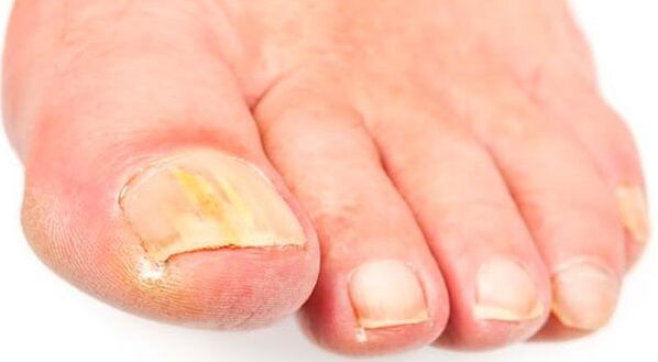 Nagelschimmel