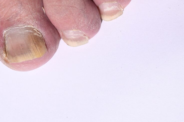 De eerste fase van mycosis van nagels op de benen