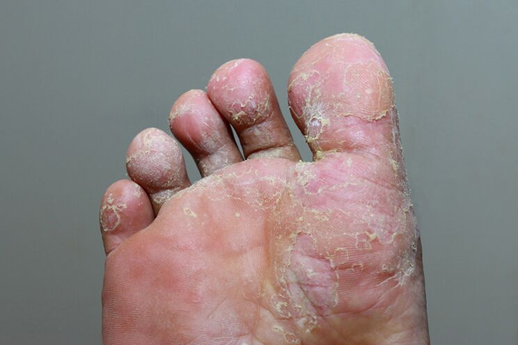 Ernstig stadium van vingerhuid mycosis