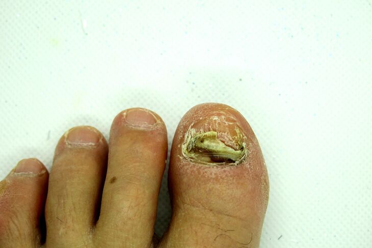 Finger Nail -schimmel - zwaar podium