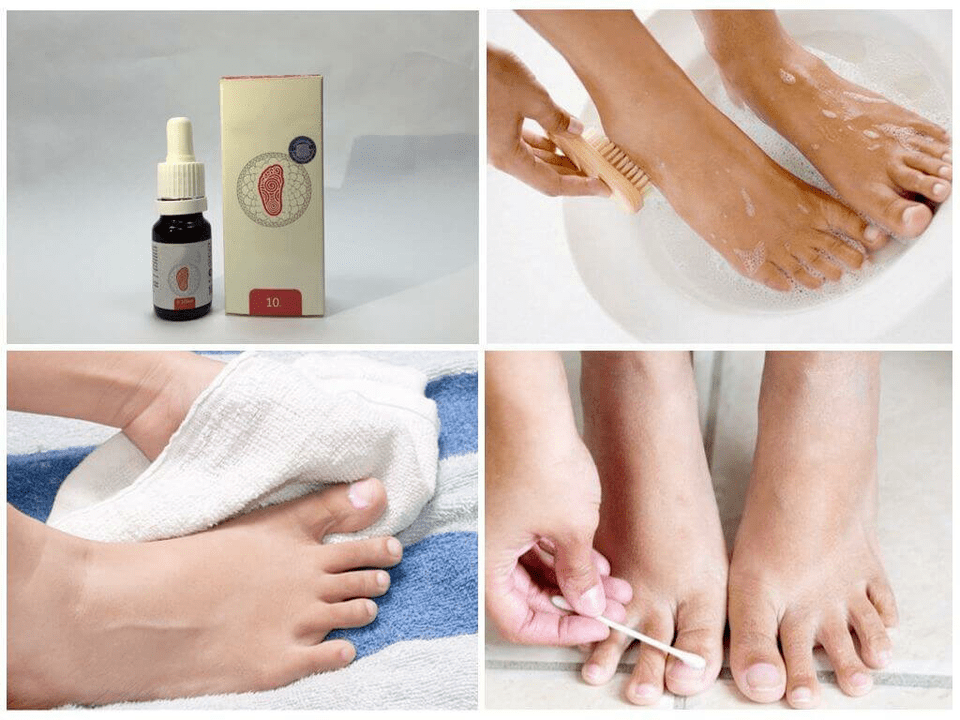 verschillende remedies tegen voetschimmel