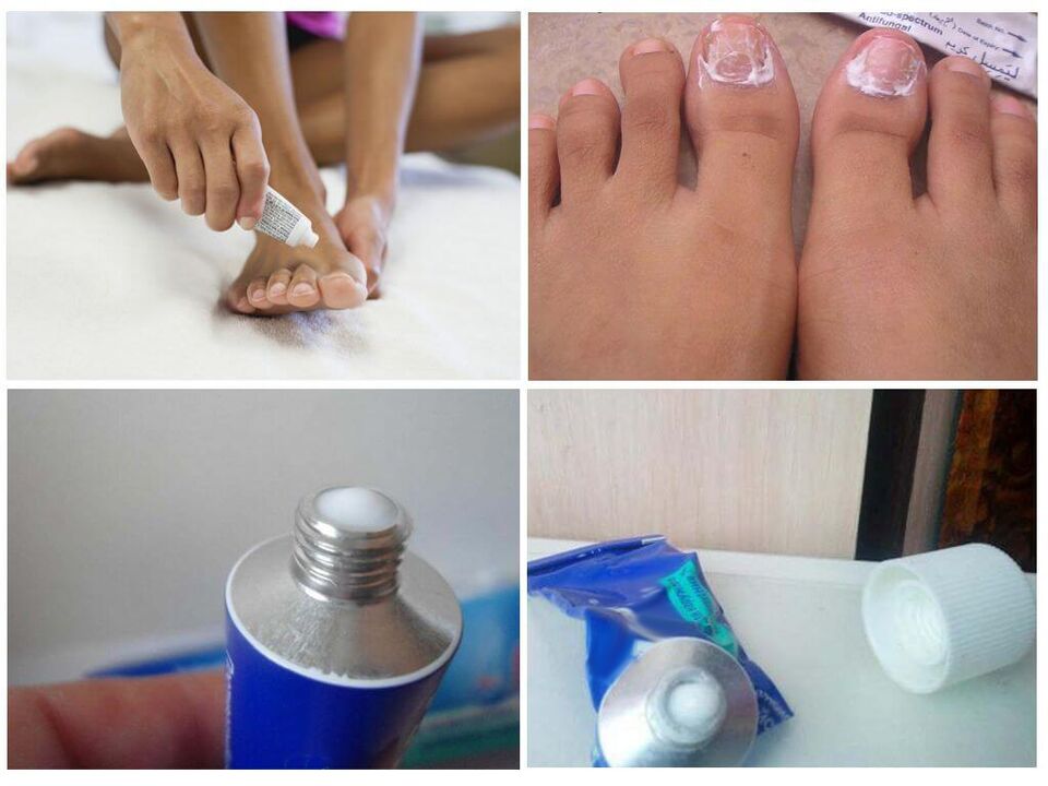 effectieve farmaceutische preparaten tegen nagelschimmel