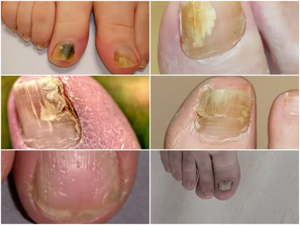 Symptomen van onychomycose - veranderingen in de kleur en structuur van nagels