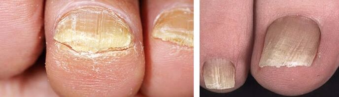 schade aan de nagels met een schimmelinfectie