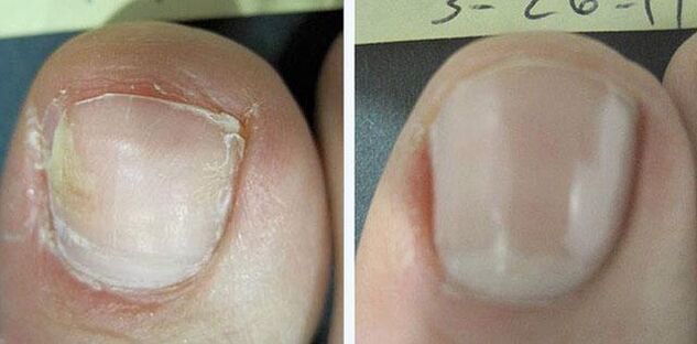 voor en na behandeling van nagelschimmel
