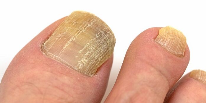 schade aan nagels met vergevorderde schimmelinfectie