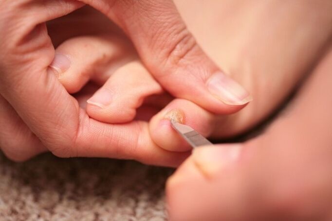 Antischimmel nagelbehandeling