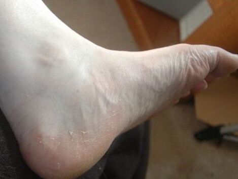 afschilfering van de voet van het been als teken van een schimmelinfectie