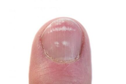 het beginstadium van een schimmelinfectie van de nagels