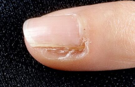 verwijderen van een deel van de nagel met schimmel
