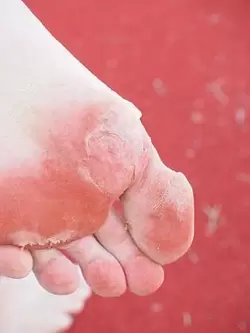 symptomen van voetschimmel